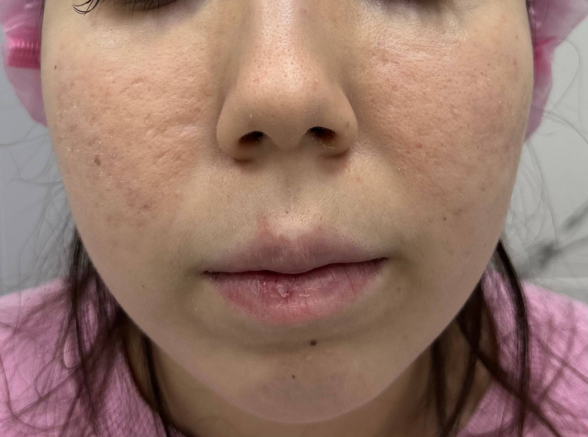 Терапия акне — после