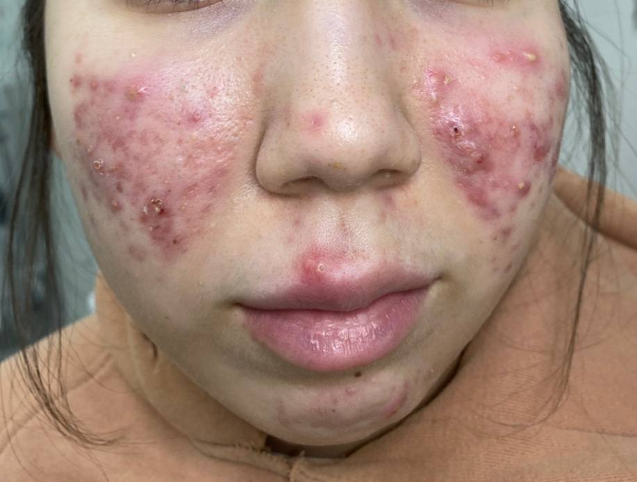 Терапия акне — до