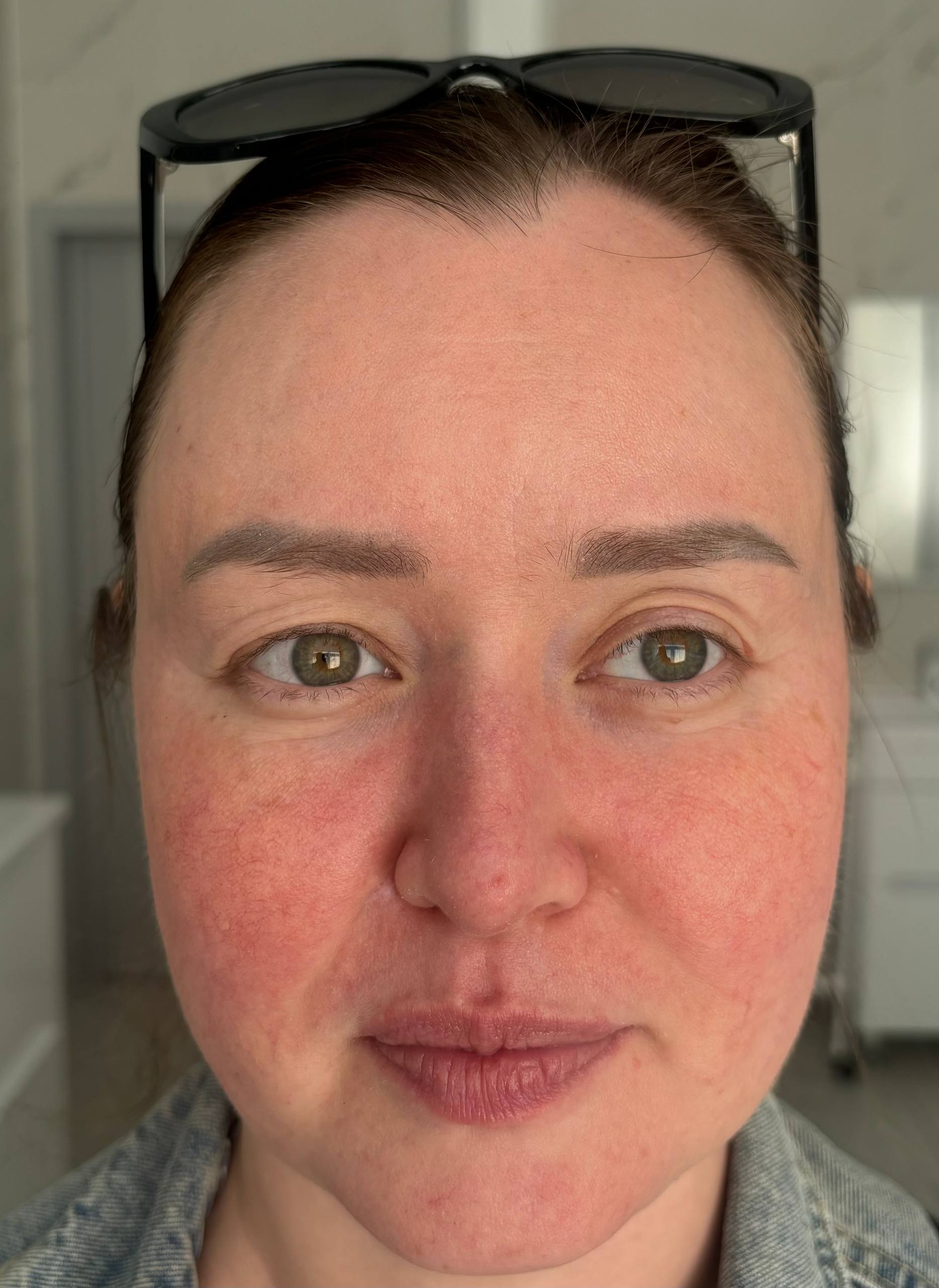 Терапия Розацеа — после