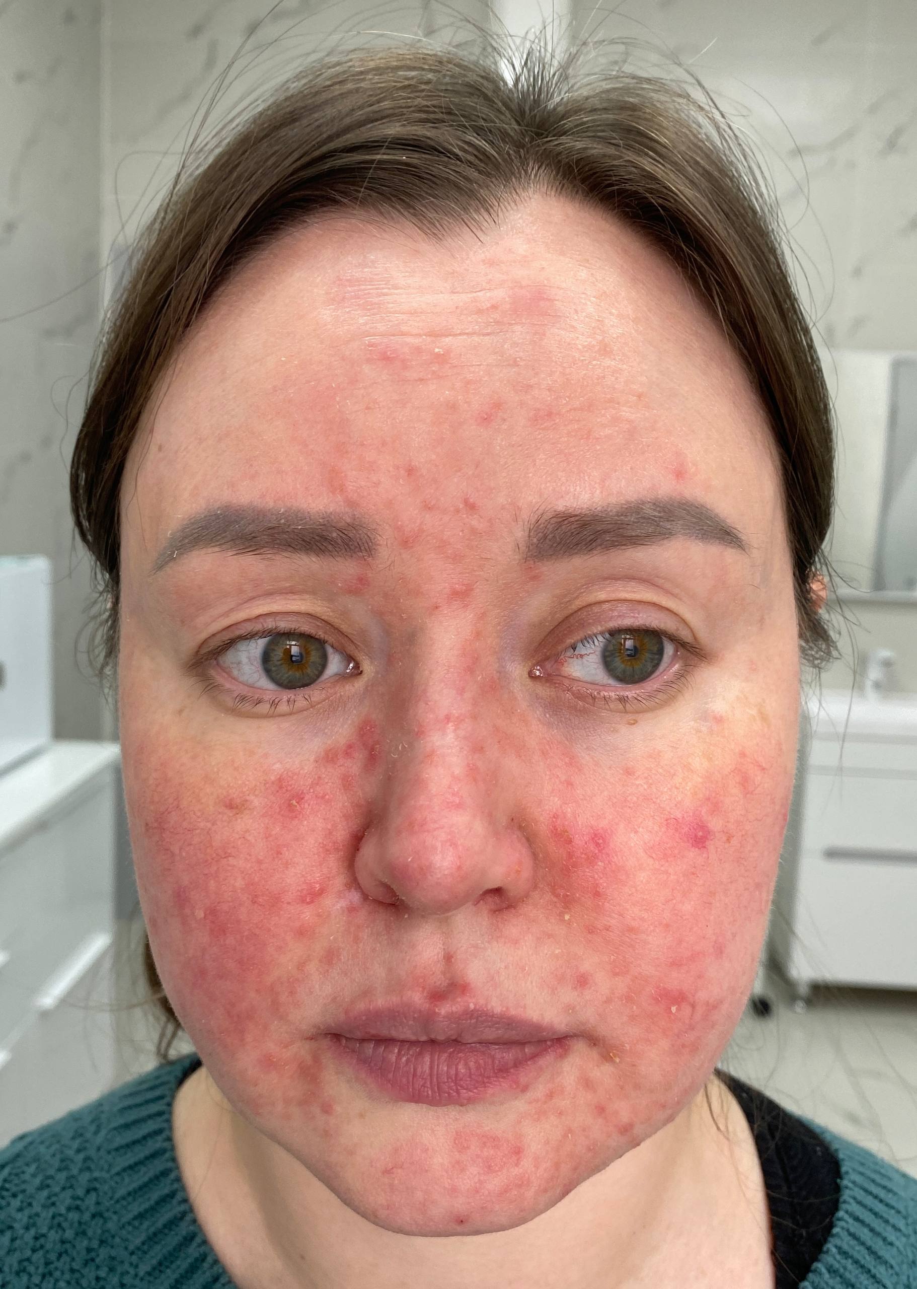 Терапия Розацеа — до