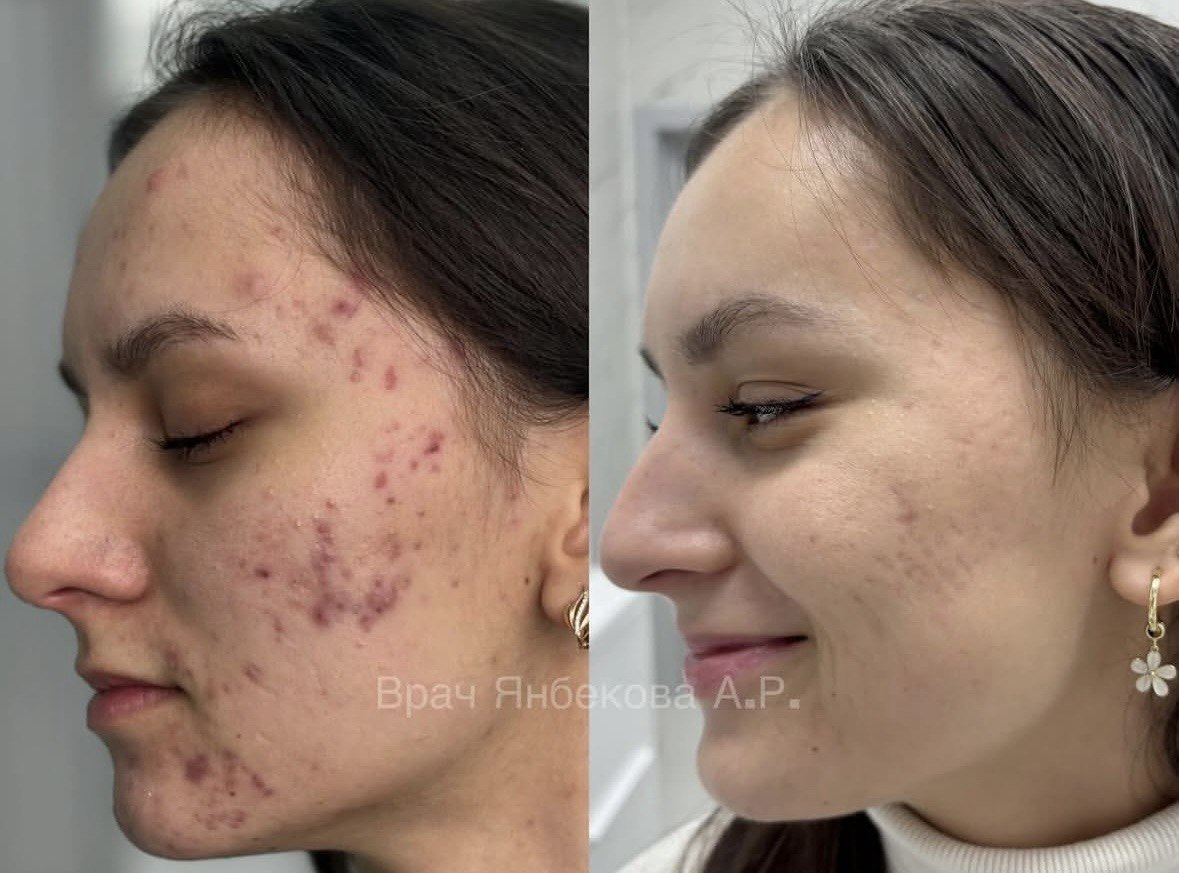 До и после лечения кожи — результат