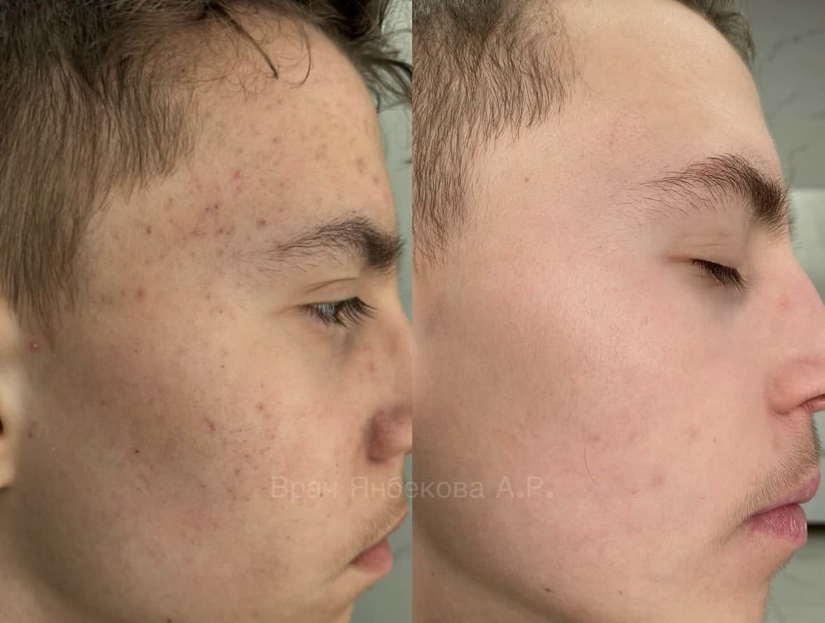 Лечение заболеваний кожи — до и после