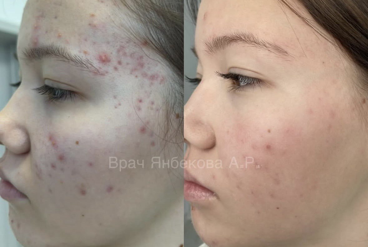 Сравнение состояния кожи до и после