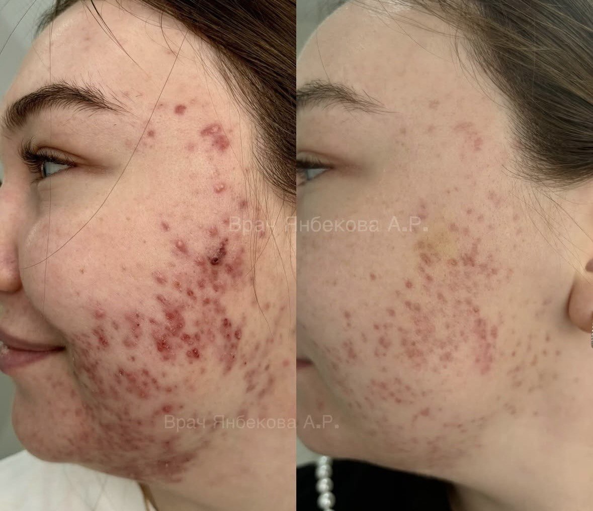 Дерматология — результат лечения