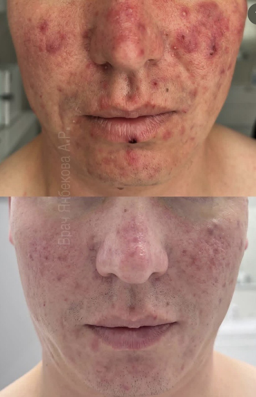 Результат терапии кожи — до и после