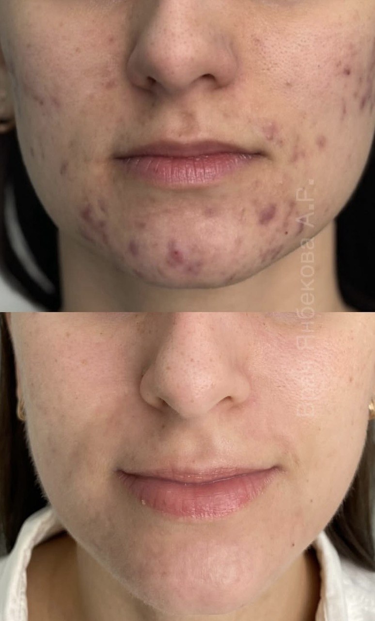 До и после курса лечения дерматоза