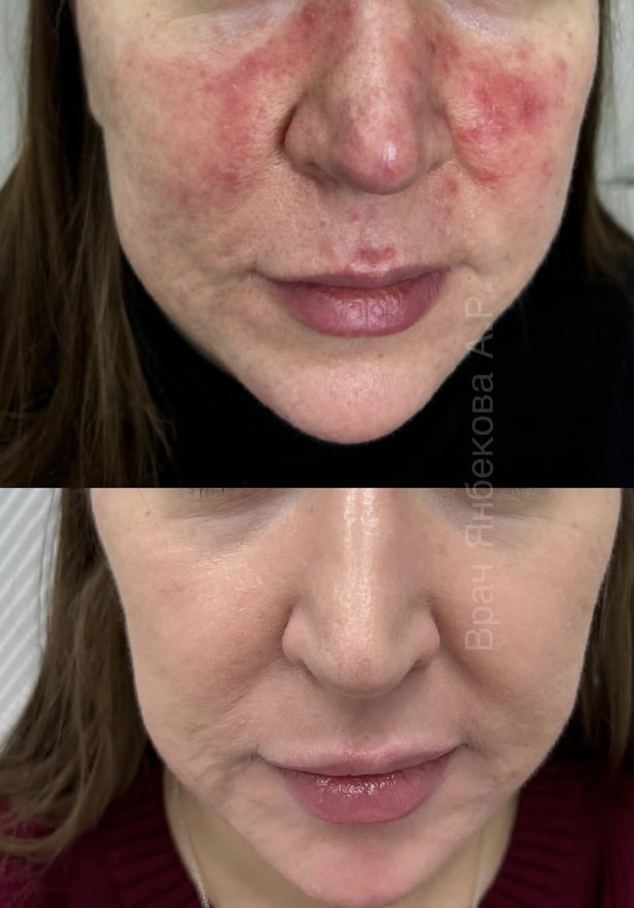 Результат лечения у дерматолога — до и после