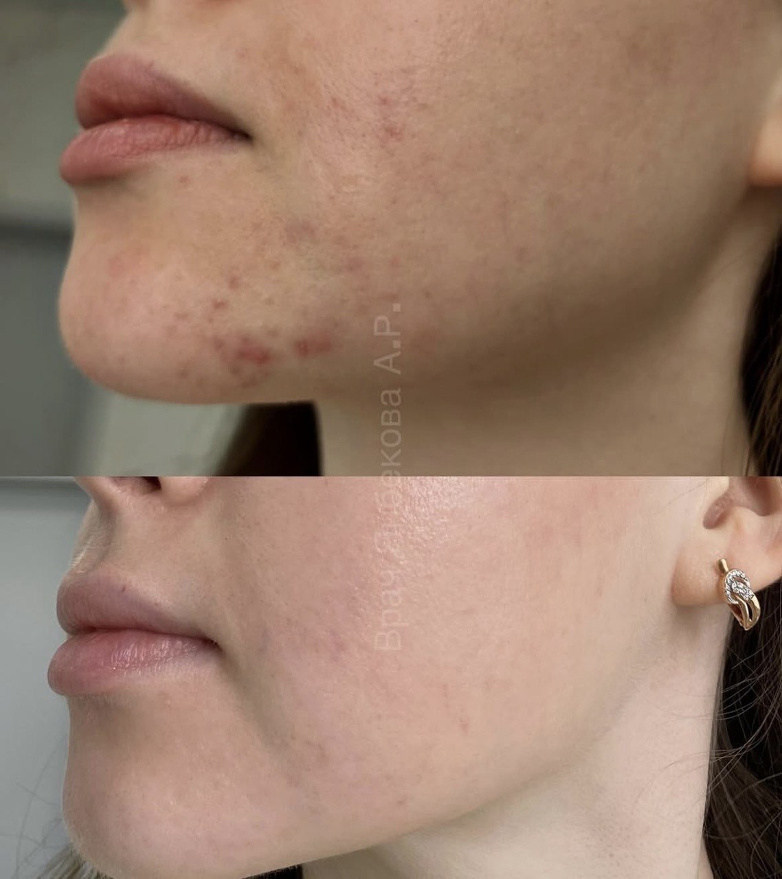 Кожа до и после индивидуального курса