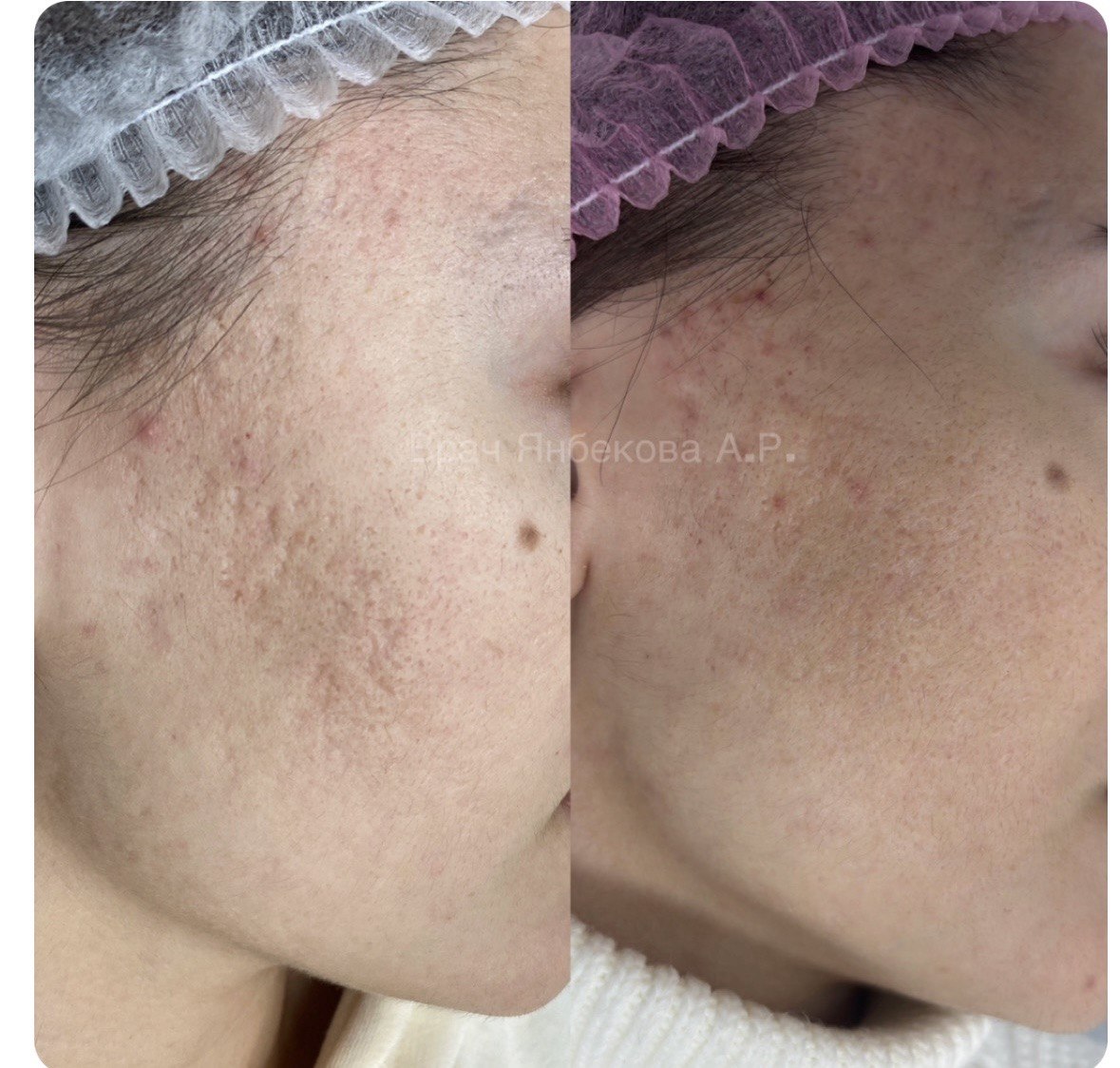 Лечение рубцов — сравнение результата