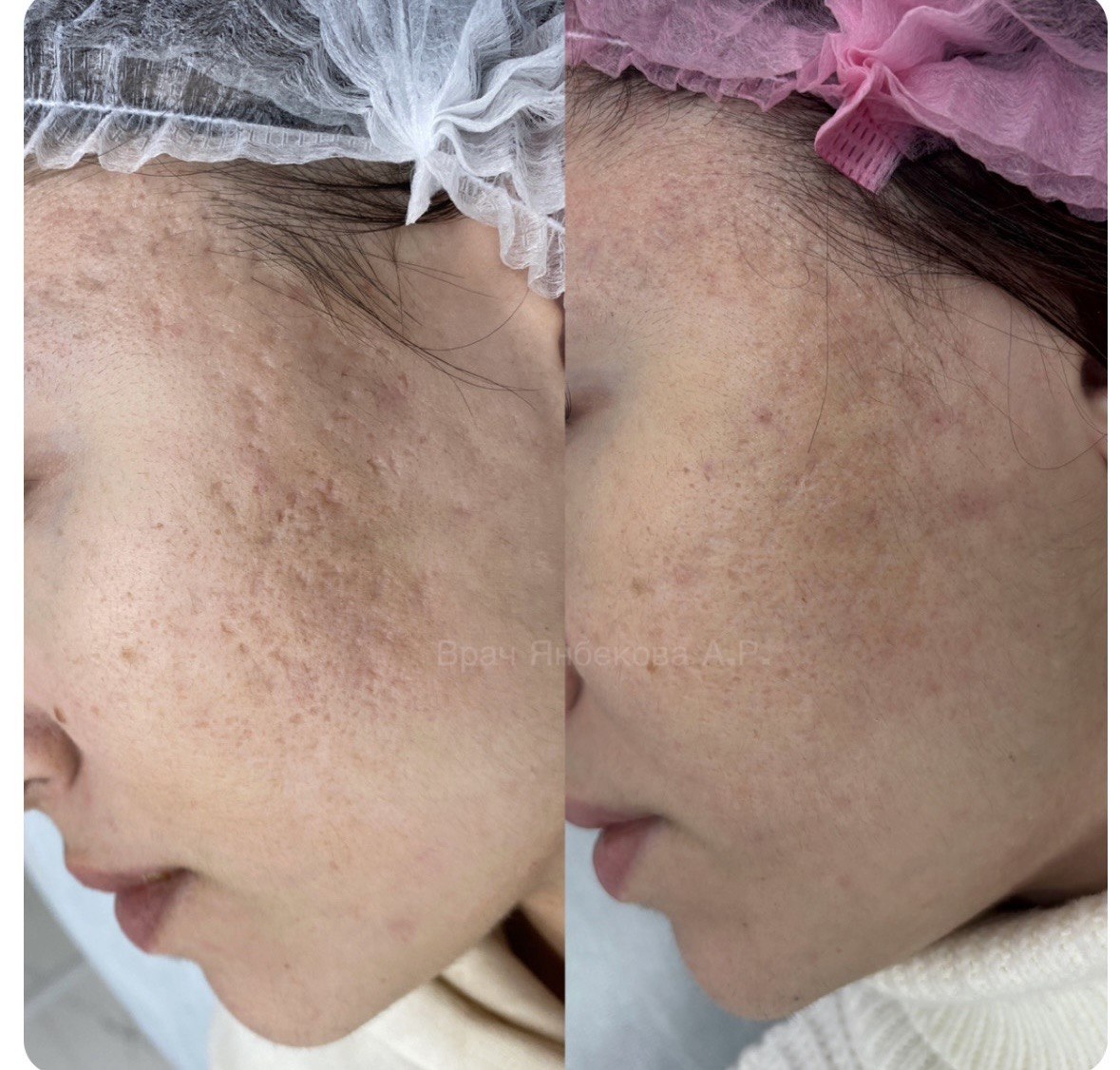 Коррекция рубцов — клинический результат