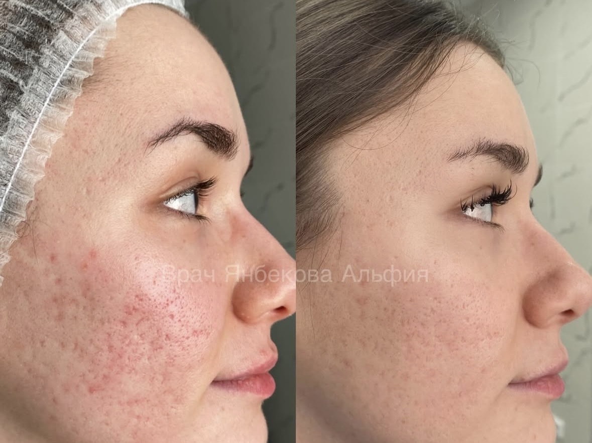 Коррекция рубцов — до и после лечения