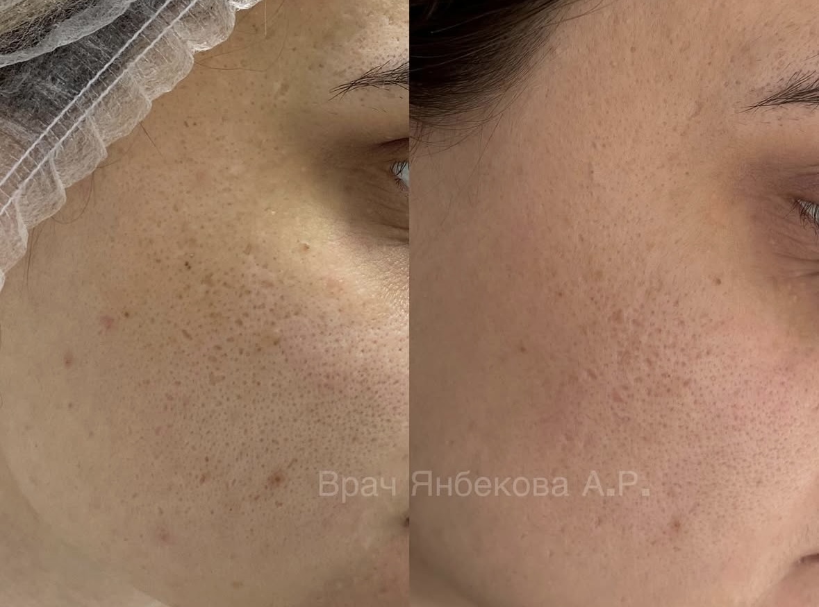 Коррекция рубцов постакне — результат