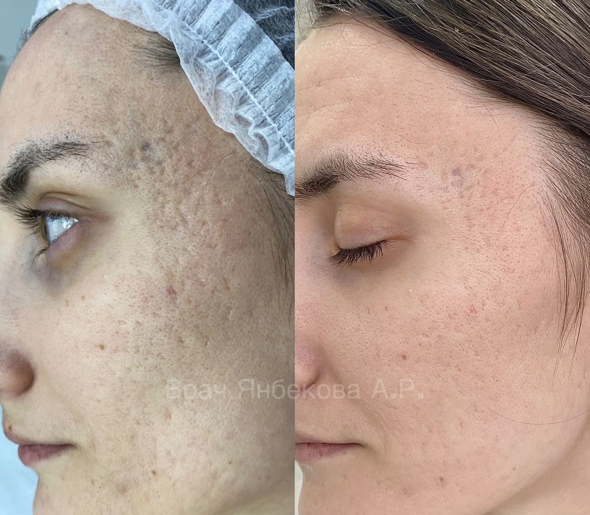 До и после лечения рубцов на коже