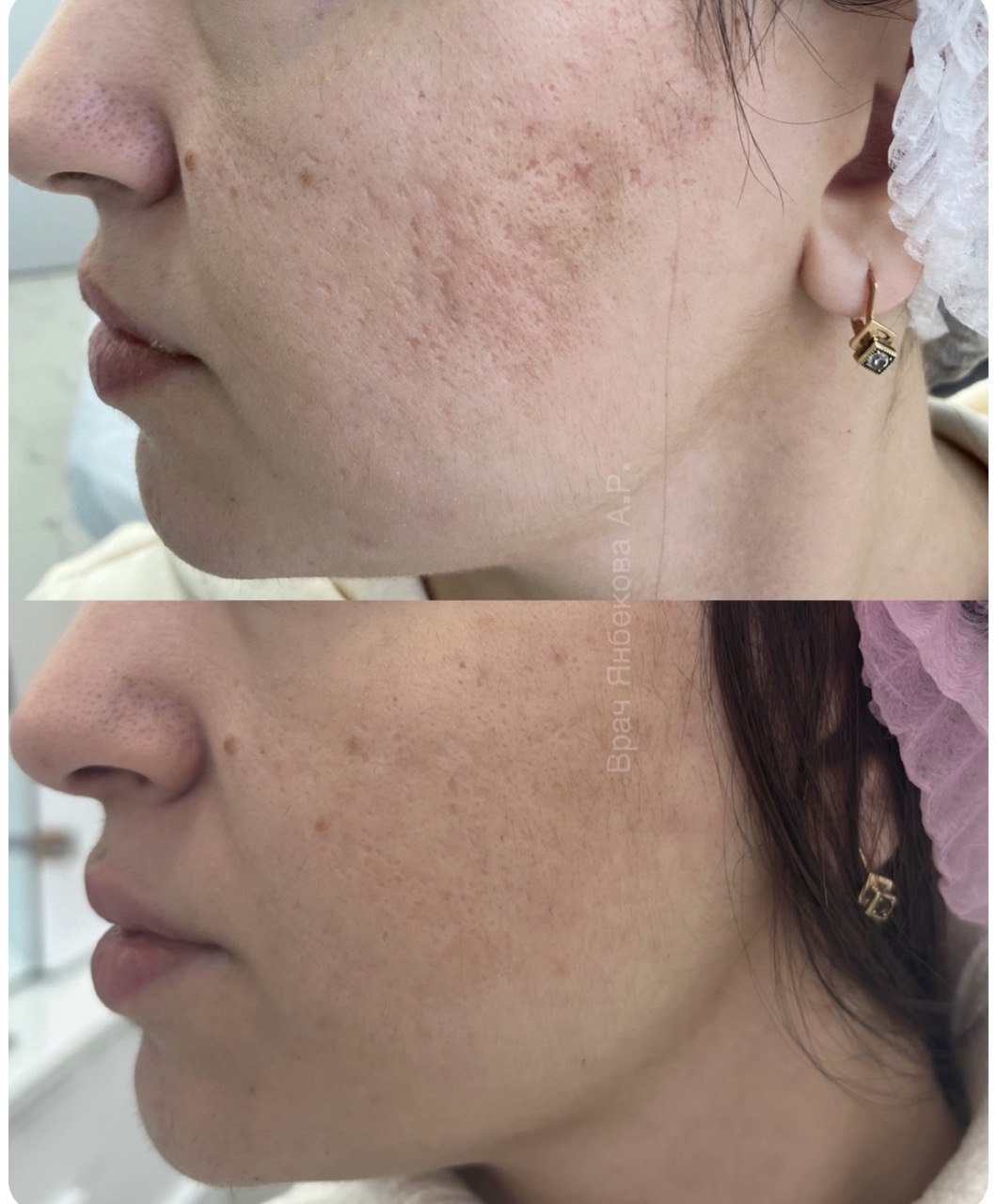 Рубцы до и после курса процедур