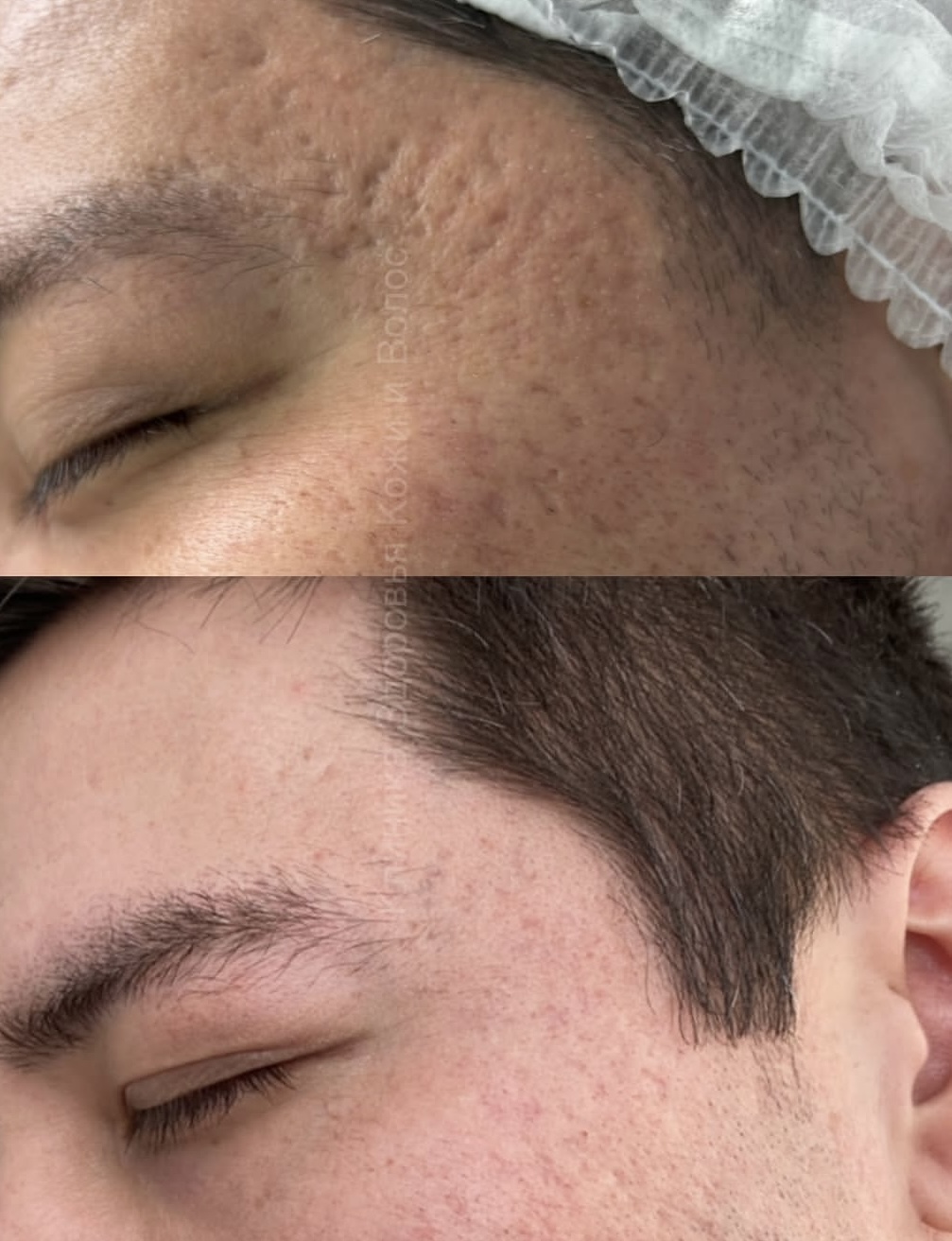 Результат лечения рубцов — до и после